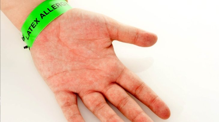Latex Allergy: Symptoms and Causes